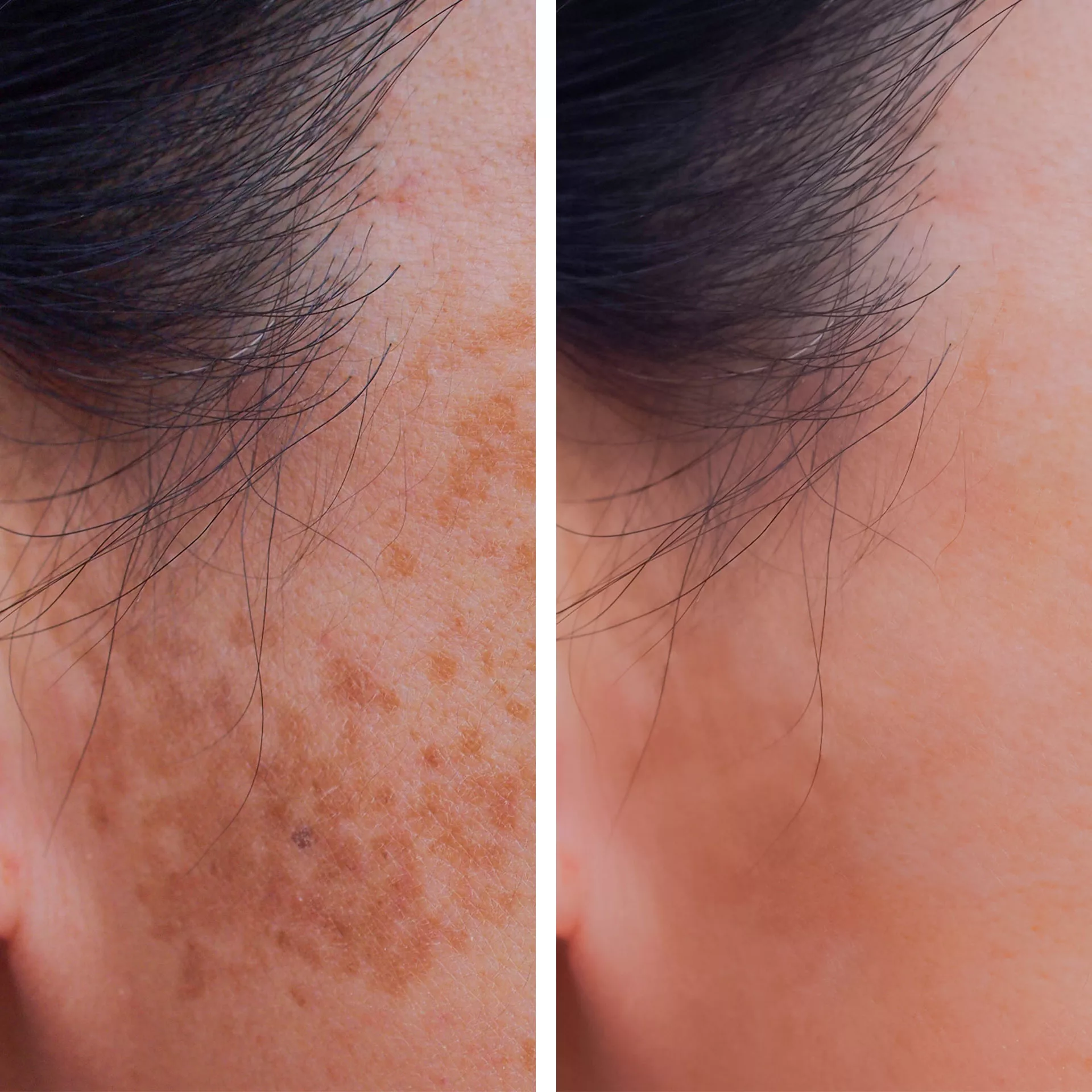 IPL laser treatment before and after sun spots and pigmentation