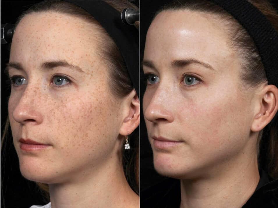 Before and after fractional laser resurfacing for skin texture and rejuvenation