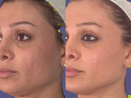 Before and after Alma Pixel fractional laser resurfacing for acne scars