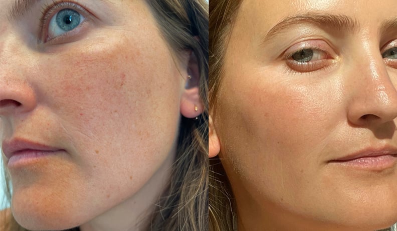 Before and after laser treatment for broken capillaries on the face